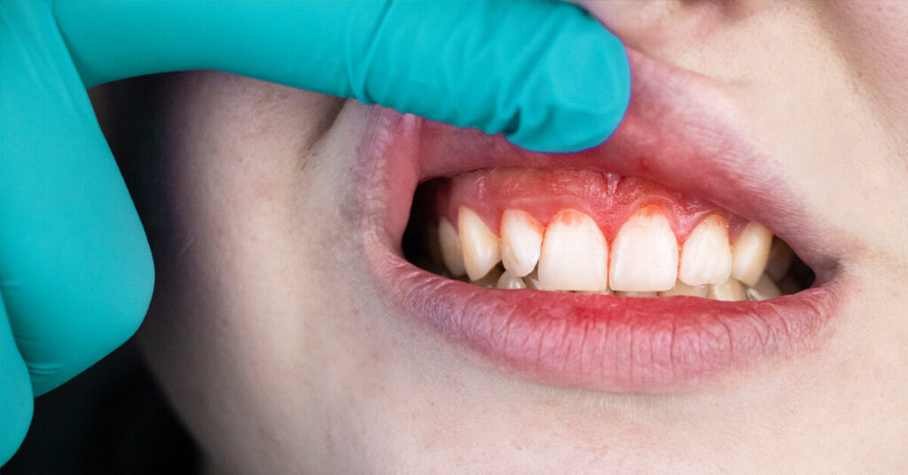 The difference between gingivitis and periodontitis