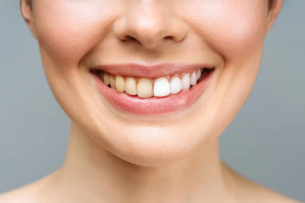 What are the Main Causes of Teeth Discoloration?