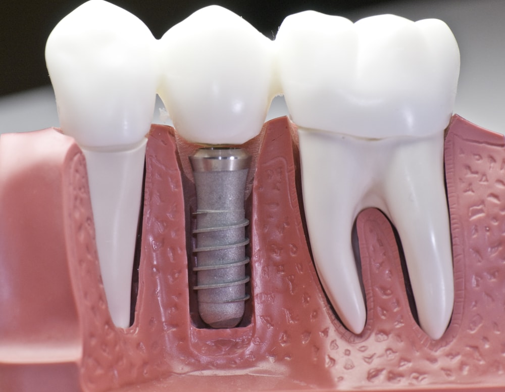 Dental Bridges vs Dental Implants in Sterling Heights: Which Option is Right for You?