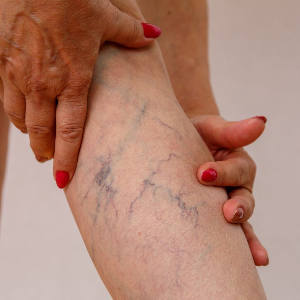 6 Main Causes of Spider Veins
