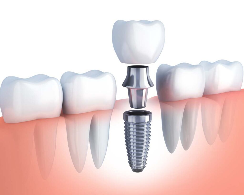 Top 5 Benefits of Dental Implants