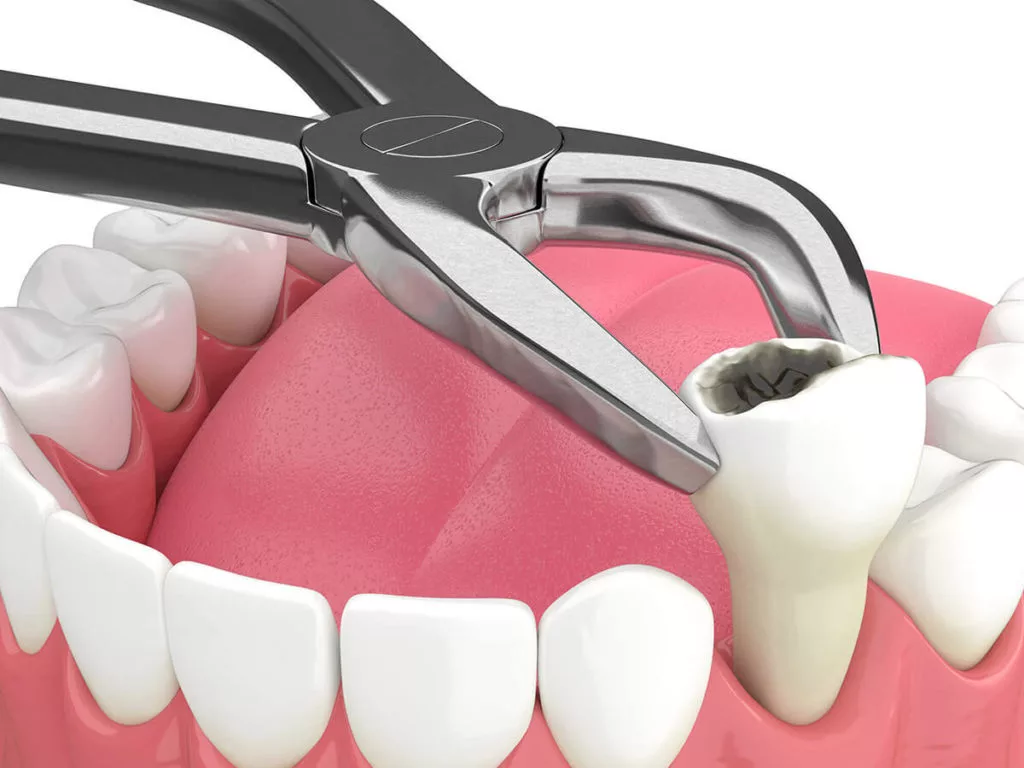 When You Cannot Avoid a Tooth Extraction in Scottsdale