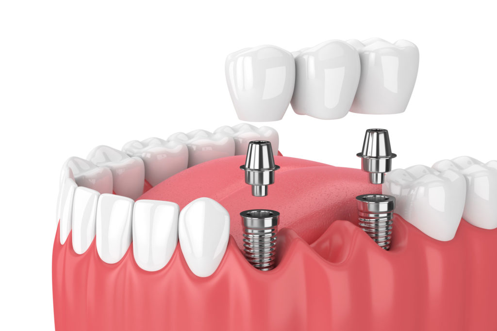 Getting dental implants in Roanoke: A look at top FAQs