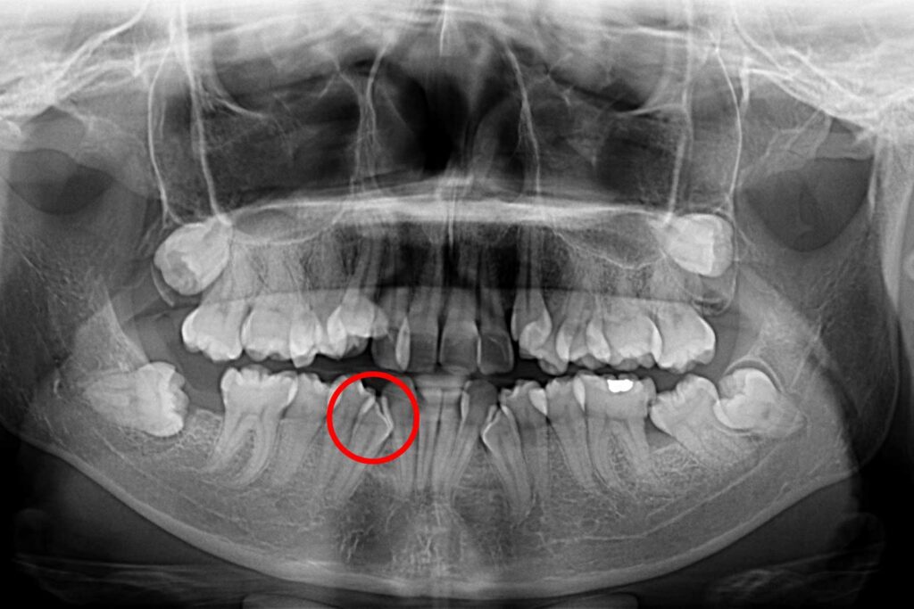 How to Tell if Your Canine is Impacted in Wilmington