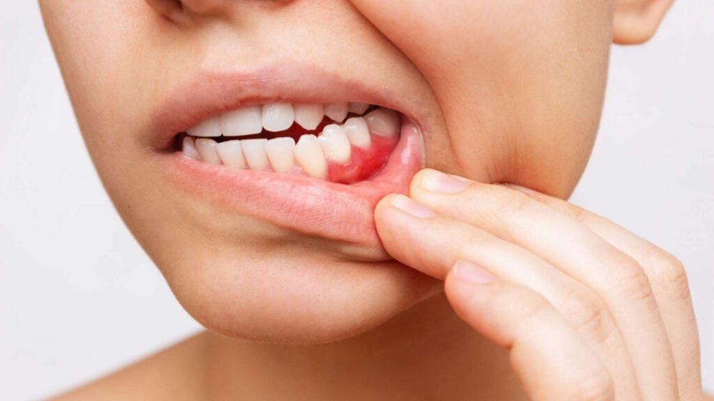 Bleeding Gums- Should You Worry?