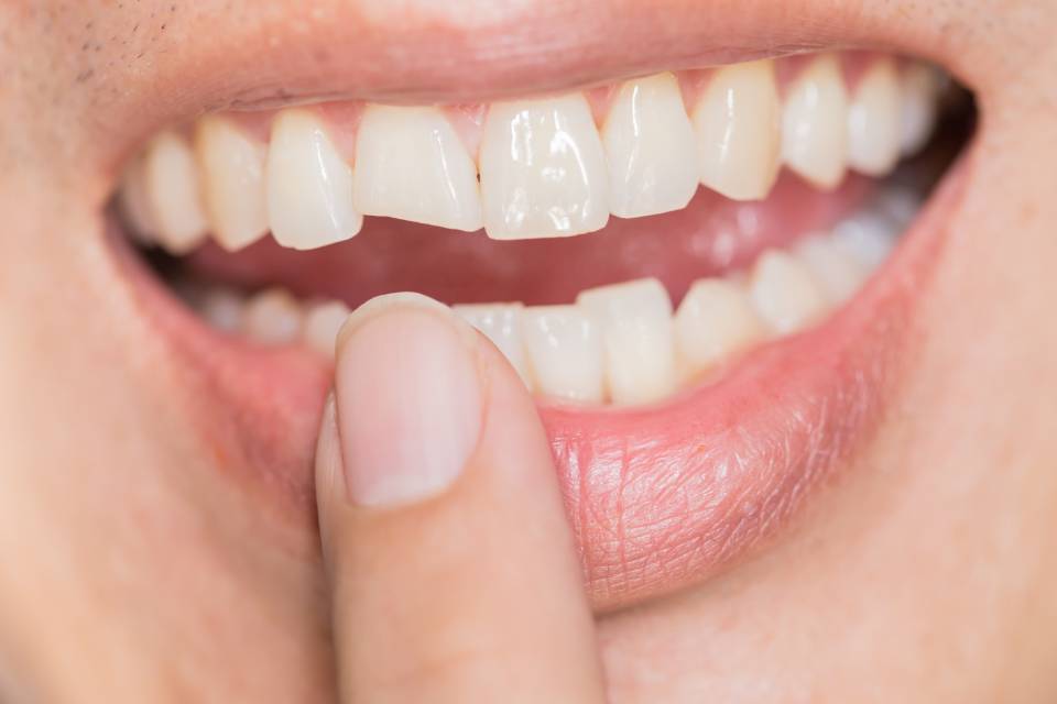 Loose Teeth in Adults – Causes and Treatment