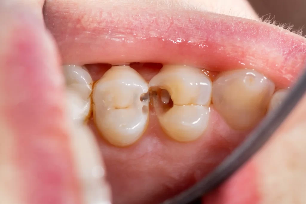 Dental Caries: Prevention and Treatment in Woodbridge