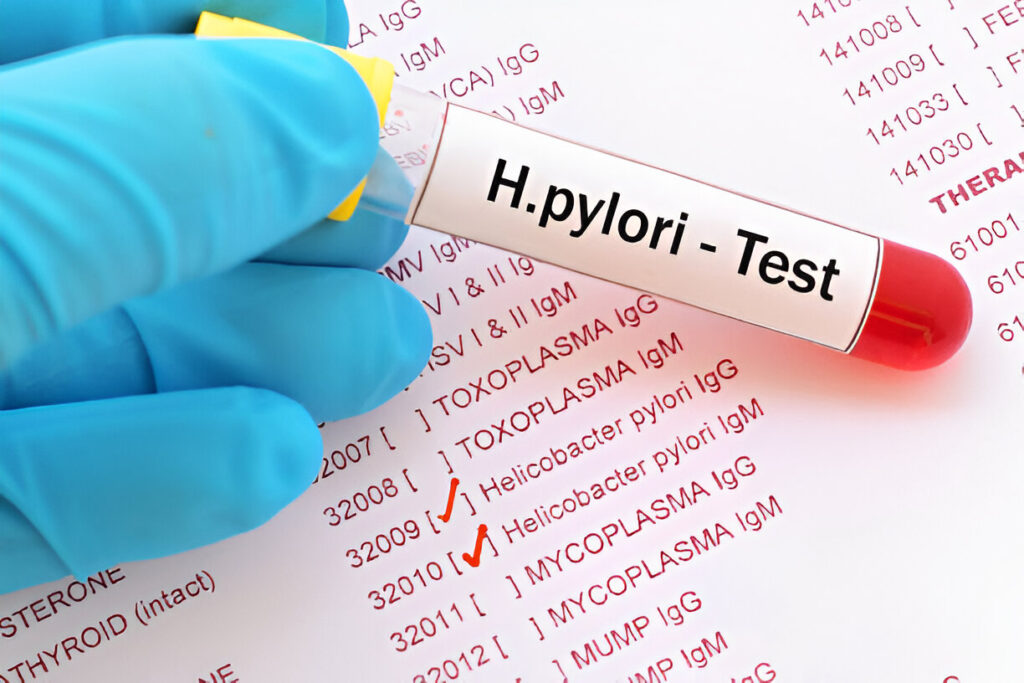 A Comprehensive Guide to Helicobacter Pylori Tests
