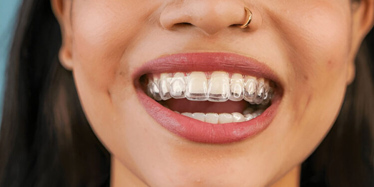 YOUR INVISALIGN JOURNEY EXPLAINED: FROM FIRST CONSULTATION TO A CONFIDENT SMILE
