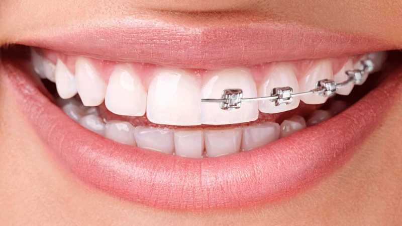Invisalign vs. Traditional Braces: Why More People Are Choosing Invisalign