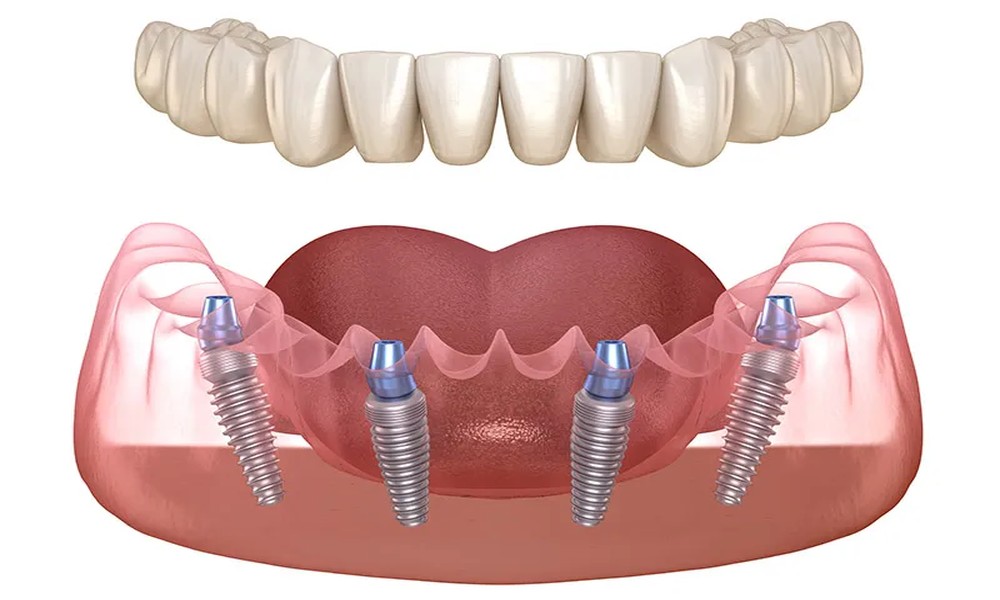 Understanding Archpoint Implant Dentistry: What I Wish I’d Known